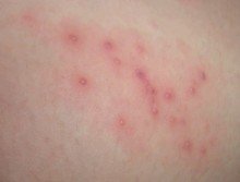 湿疹由哪些原因引起?