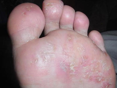 脚气的临床表现有哪些特点